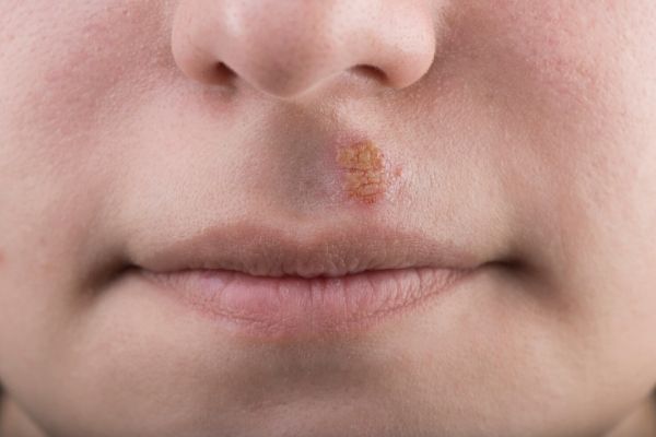 Home Remedies for Herpes